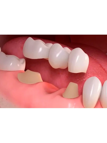 Протезирование зубов: пластмассовая коронка