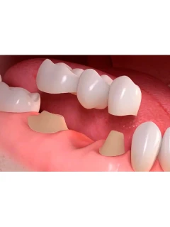 Протезирование зубов: пластмассовая коронка