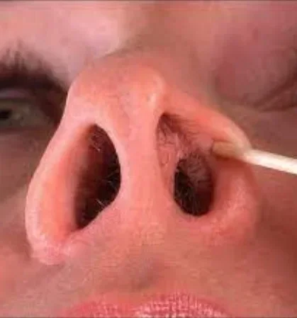 Рассечение синехий в полости носа (с одной стороны)