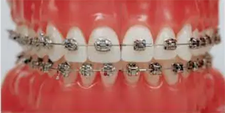 Услуги стоматолога - ортодонта: брекет-система Damon Q.
