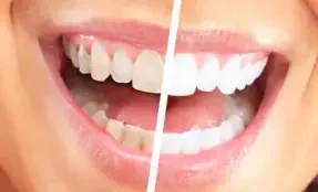 Система холодного отбеливания зубов
