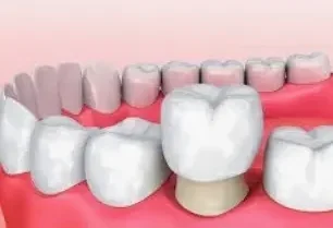 Укрепление корня зуба