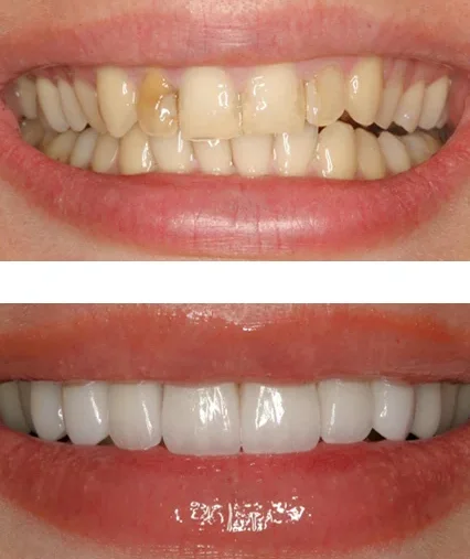 Восстановление зуба прямыми винирами. Пакет "Класс А"