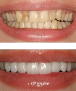 Фото для Восстановление зуба прямыми винирами. Пакет "Класс А"