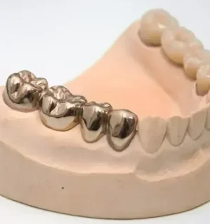 Несъемное протезирование: Восстановление зуба постоянной металлической коронкой