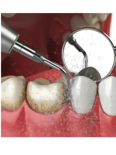 Фото для Удаление зубного камня