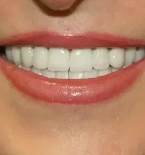 Фото для Несъемное протезирование: Восстановление зуба корневым аттачментом