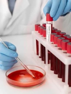 
Анализ крови на общий белок, общий холестерин