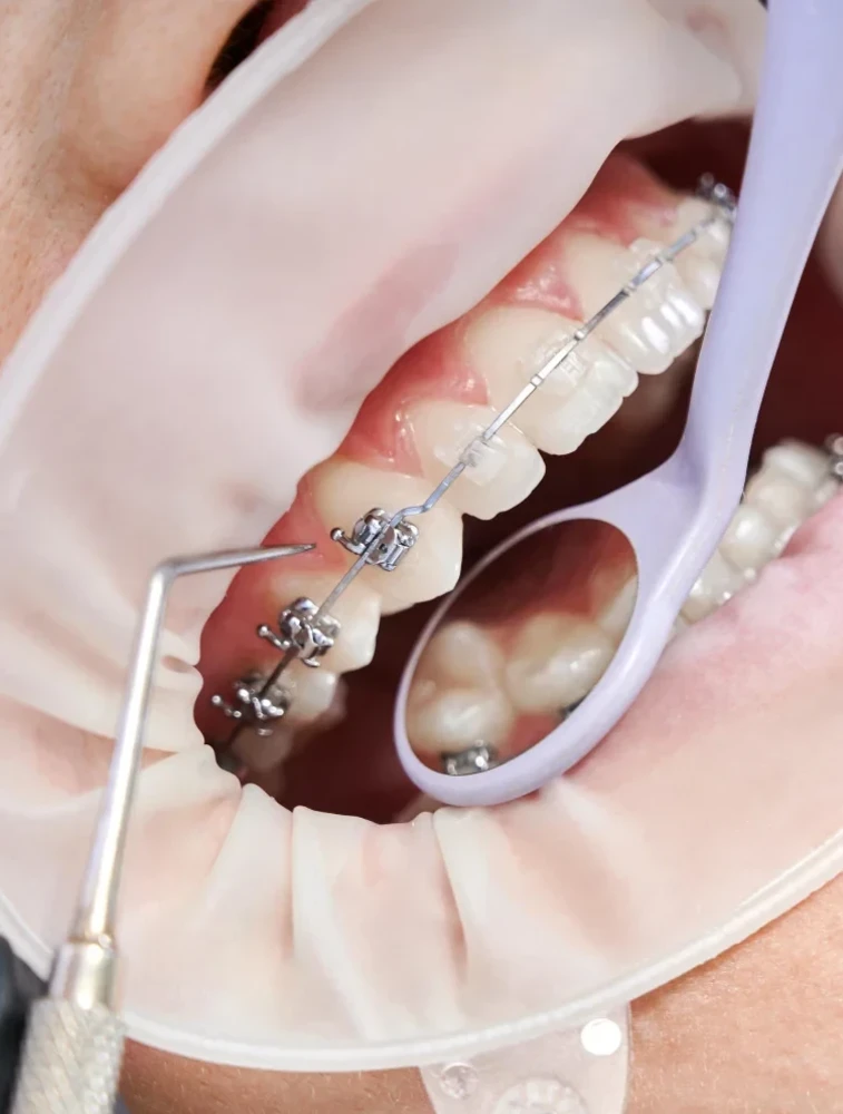  Установка брекет - систем Damon Q