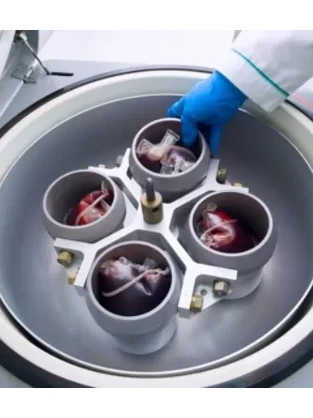 Плазмоферез центрифужный прерывный