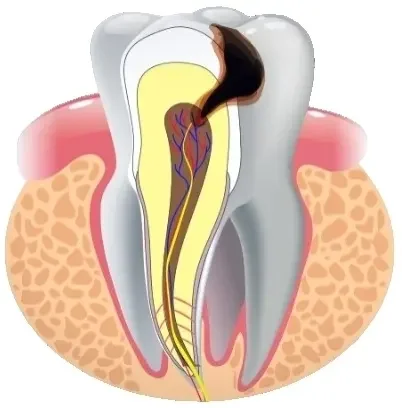 Фото для Лечение пульпита/периодонтита молочного зуба