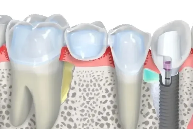 Восстановление зуба циркониевой коронкой
