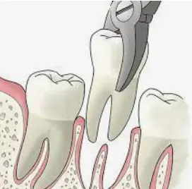 Услуги стоматолога: простое удаление зуба
